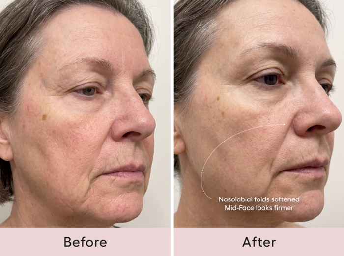 Before and after comparison, three-quarter view of a woman's nasolabial folds and mid-face